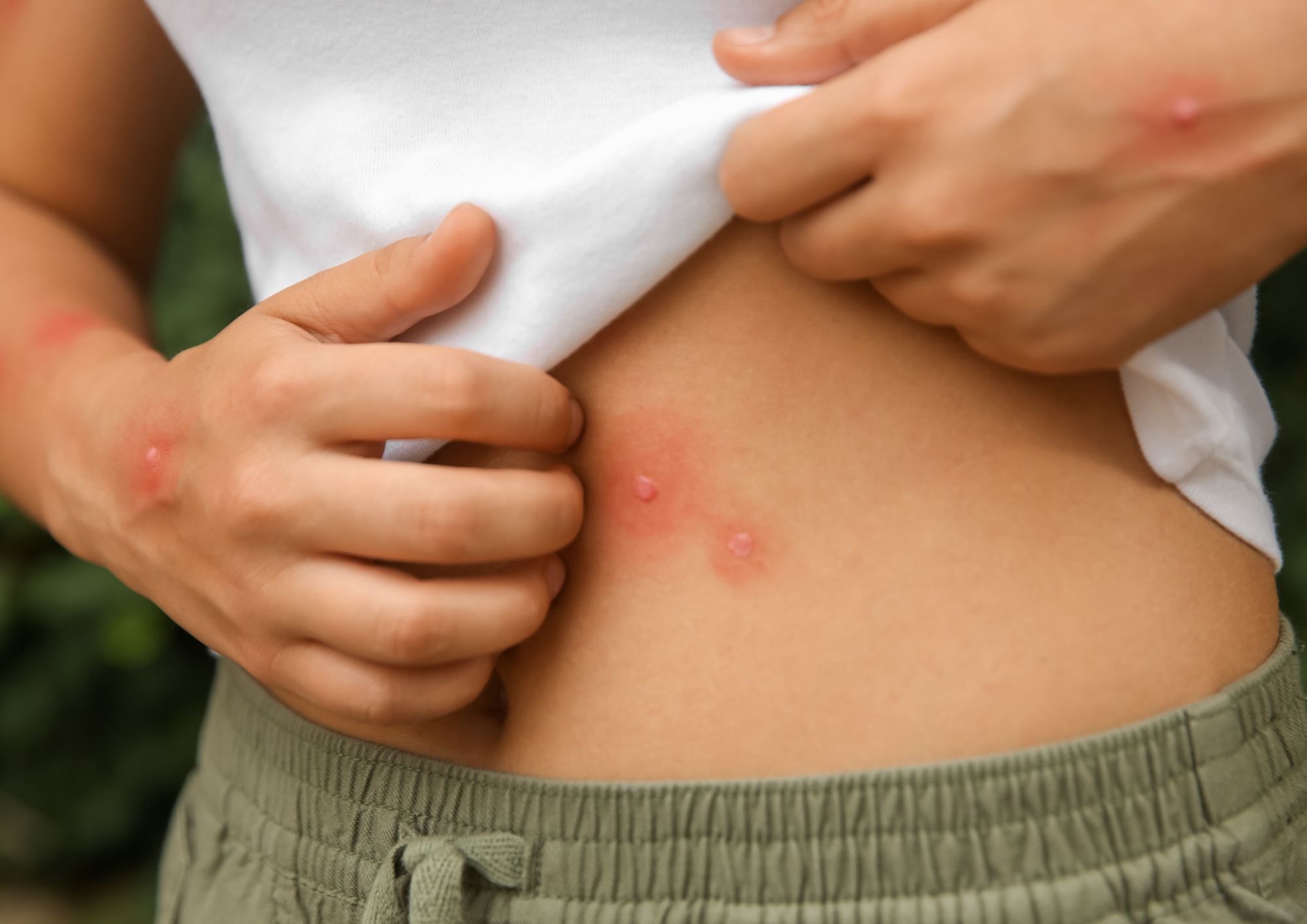 Homeopathy for insect bites: natural remedies for quick relief